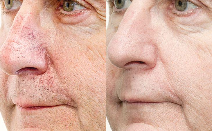 Можно ли делать BBL летом? Разрушаем мифы о сезонности в косметологии