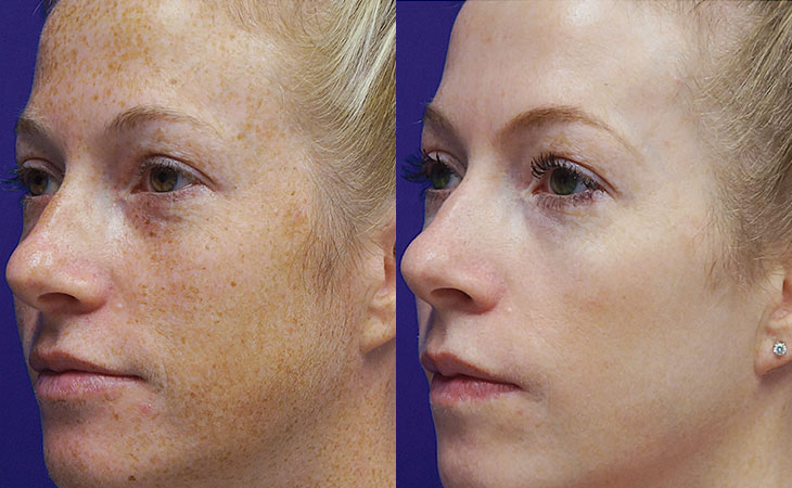 С какого возраста можно делать BBL и не поздно ли начать после 50